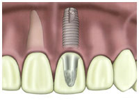Dental implant root base in bone.