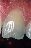This badly chipped tooth can be repaired with dental bonding.