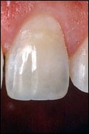Chipped tooth repaired by dental bonding.
