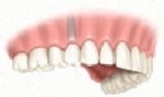 Dental implants are rapidly replacing dental bridges as the treatment of choice for missing teeth.