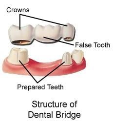 Diagram depicting structure of typical dental bridge