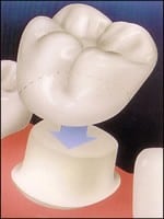 porcelain crown being placed on a molar