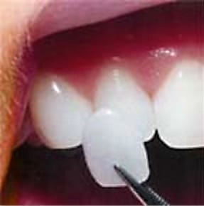picture of a porcelain veneer being placed on a prepared tooth