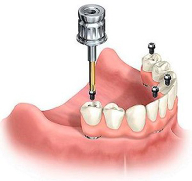 Diagram of lower affordable dental implants with four screws