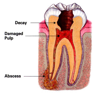 Diagram of abscessed tooth in need of emergency dental care and root canal treatment