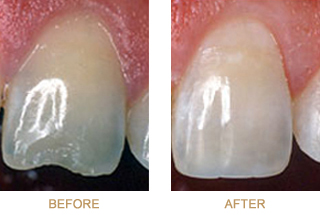 Before-and-after dental bonding photos
