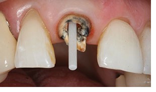 A flexible post in a rooth canal tootth to build it up in preparation for a dental crown