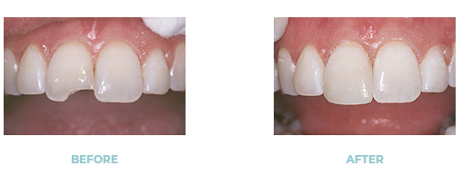 Before-an-after dental bonding photos for a broken tooth