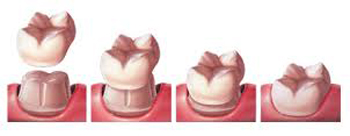 Diagram of the stages of affordable dental crowns