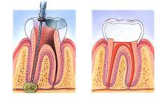 Diagram of a root canal tooth (left) and the healed tooth with a crown (right)