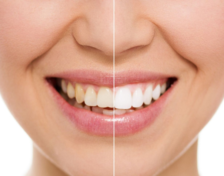 Before-and-after teeth whitening smile