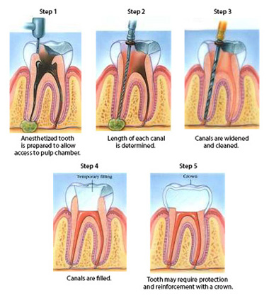 Root canal emergency diagram of five procedure steps