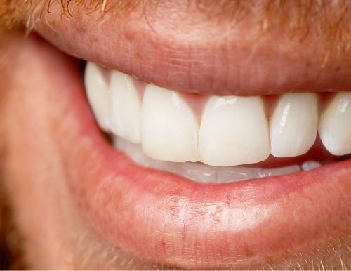 Close-up smile, portraying teeth whitening vs bonding for white spots on teeth