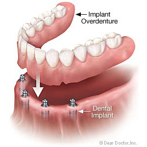 Diagram of affordable dental implants with a denture hovering over the gum ridge and implants