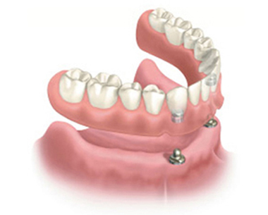 Snap-on denture as an affordable alternative to individual implants