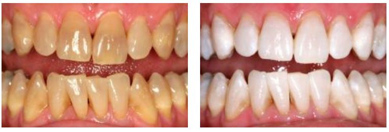 Before-and-after Kor teeth whitening photos