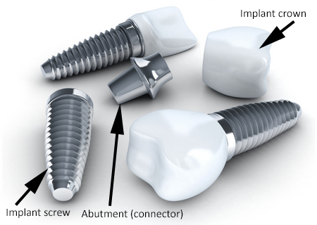 Dental implant parts, including the screw, connector, and crown, and one complete implant