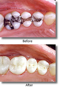 Before and after composite fillings, for information on numbing shots for dental fillings