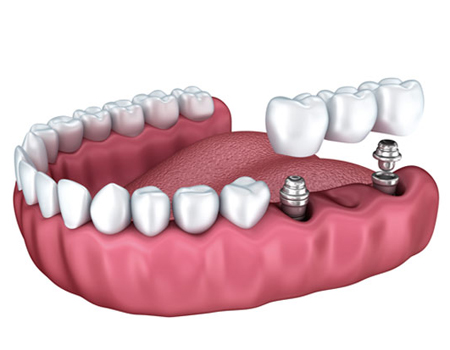 Model of a dental implant bridge for three lower molar teeth