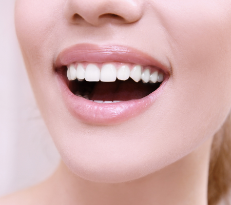 A woman's close-up smile, portraying healthy, not puffy, gums around porcelain veneers