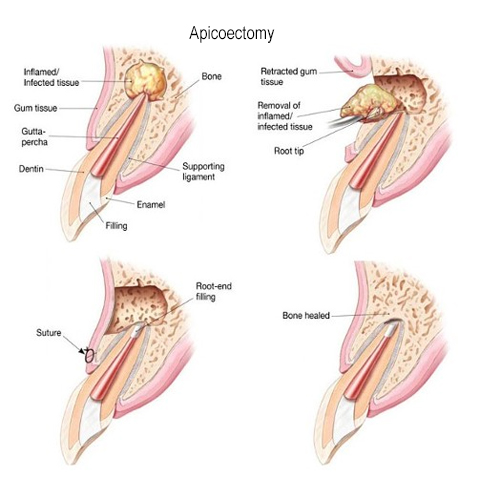 Diagram of an apicoectomy procedure