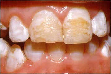 Damaged tooth enamel with white spots and brown vertical streaks from severe enamel hypoplasia